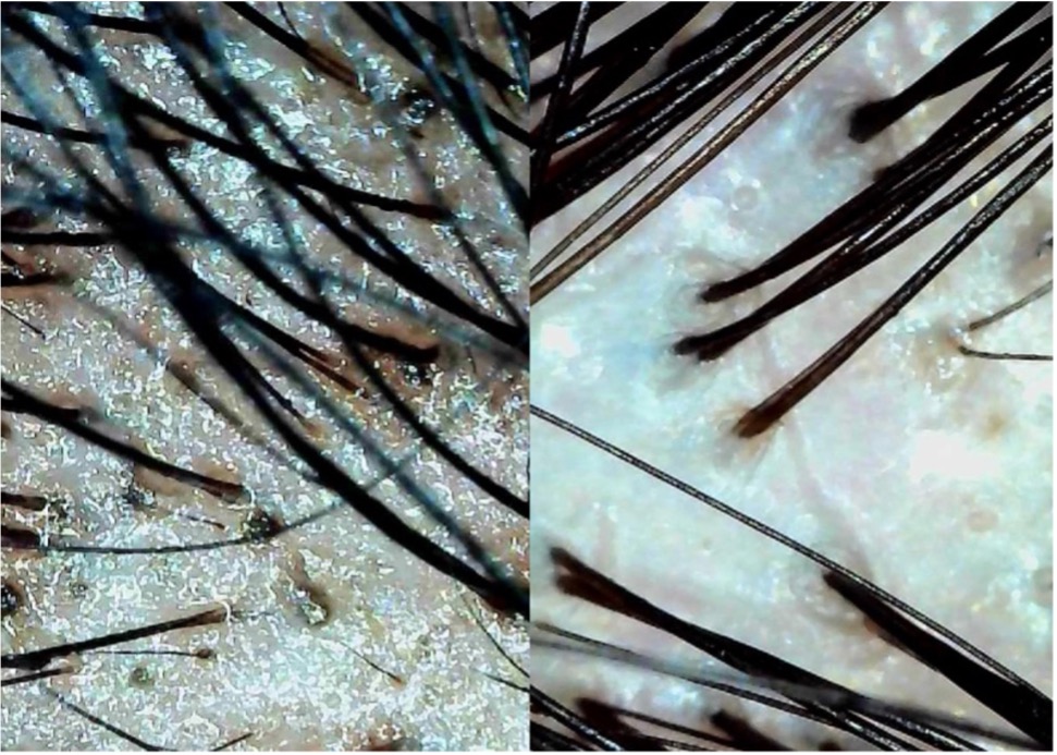 Before and After microscopic images of scalp