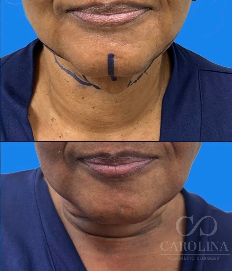 Case--3728 | Before and After Neck Liposuction 1