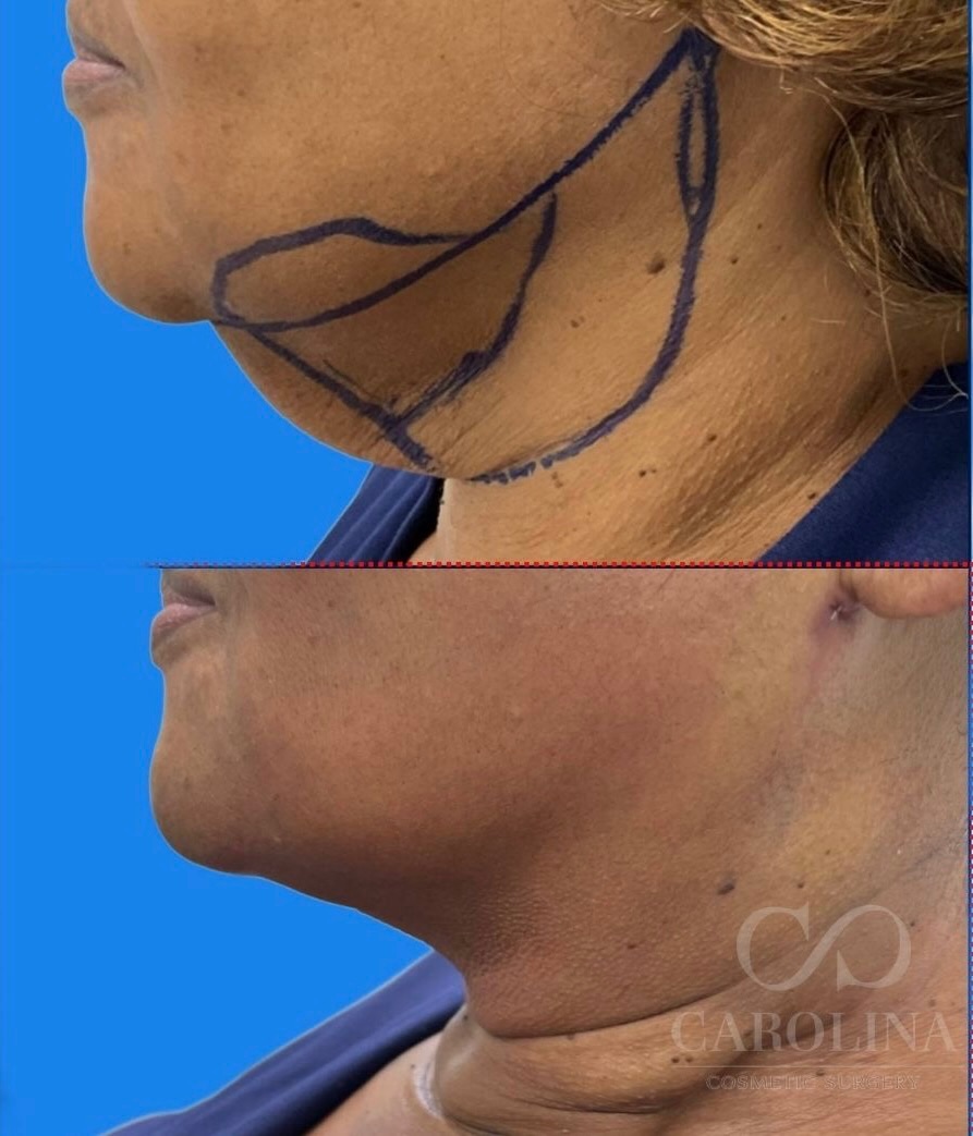 Case--3728 | Before and After Neck Liposuction 2