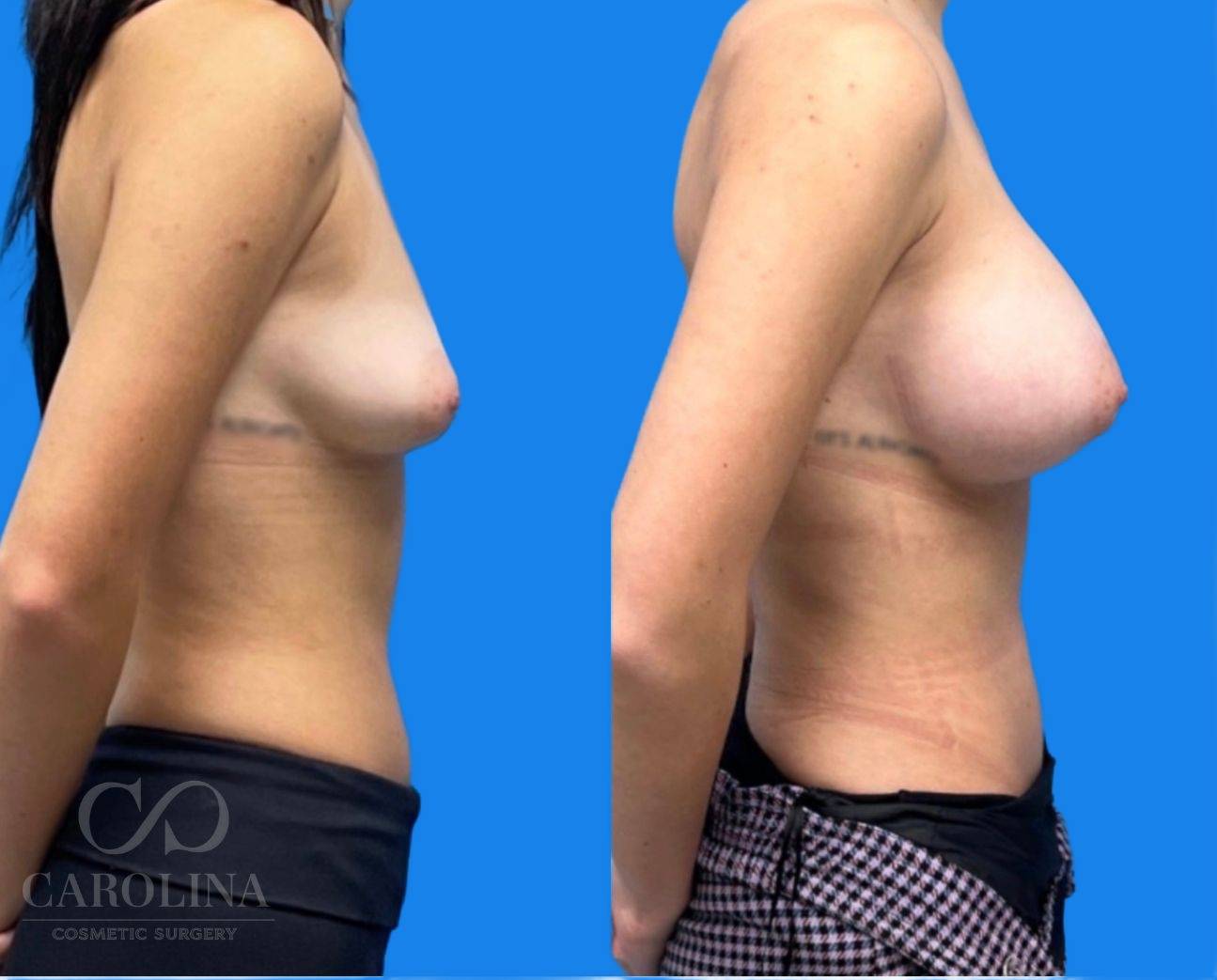 Case--8456 | Before and After Breast Augmentation 3