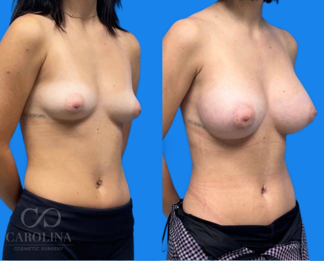 Case--8456 | Before and After Breast Augmentation 2