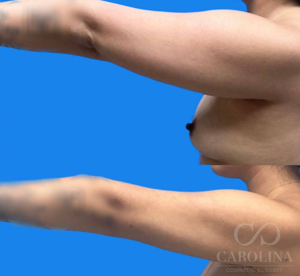 Case--6433 | Before and After Arm Sculpt 3