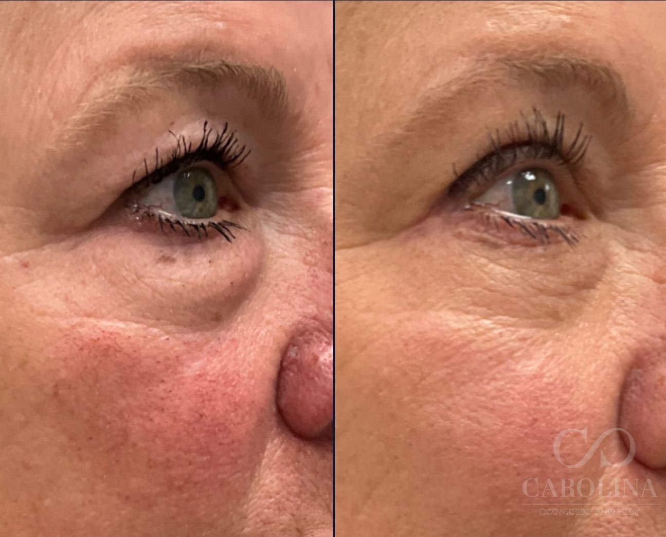 Case--6588 | Before and After Blepharoplasty 4