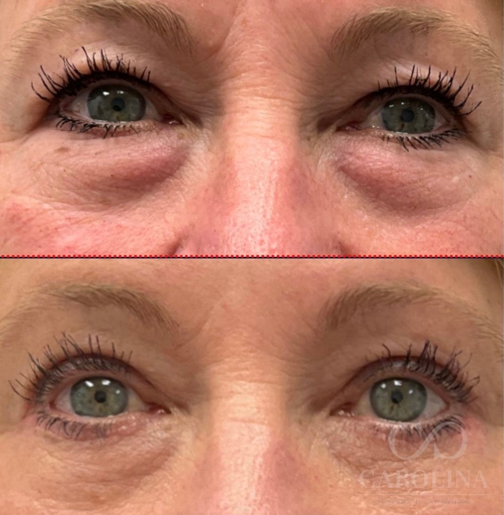 Case--6588 | Before and After Blepharoplasty