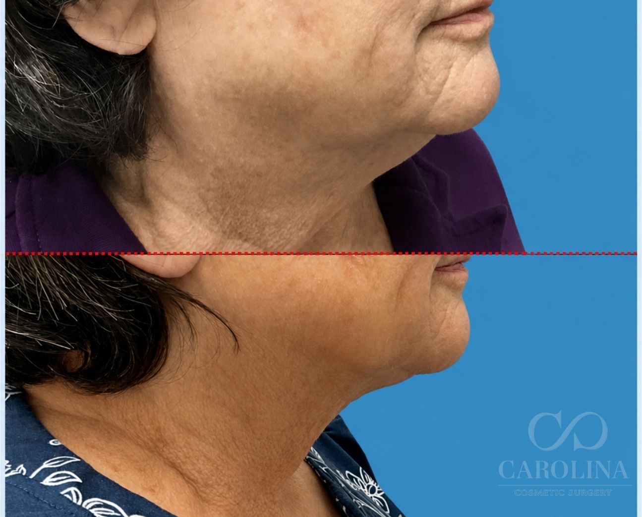 Case--9805 | Before and After Neck Liposuction + Renuvion® 2