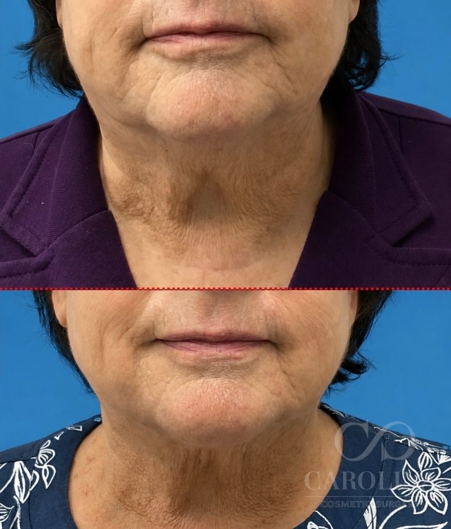 Case--9805 | Before and After Neck Liposuction + Renuvion® 1