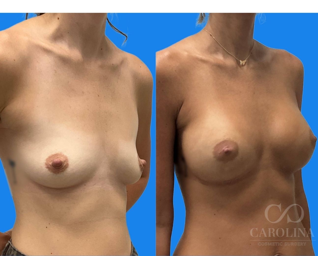 Case--2917 | Before and After Breast Augmentation 3