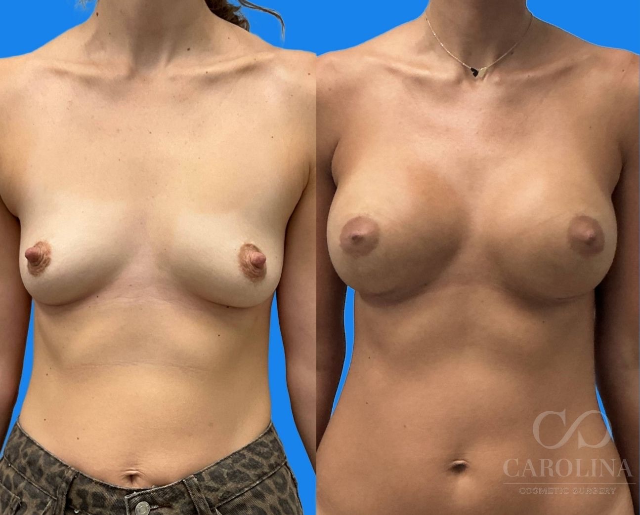 Case--2917 | Before and After Breast Augmentation