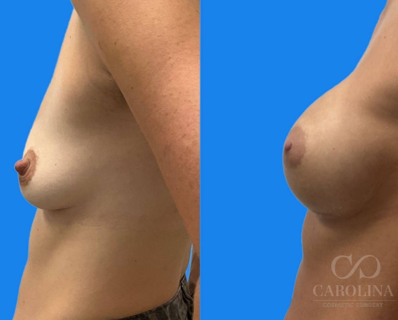 Case--2917 | Before and After Breast Augmentation 2