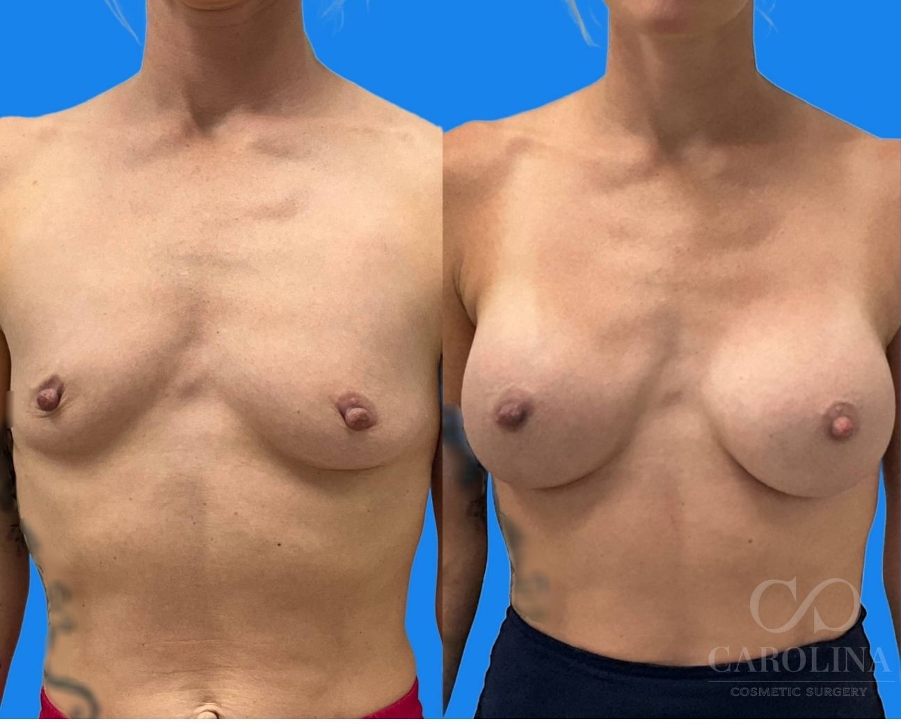 Case--5871 | Before and After Breast Augmentation