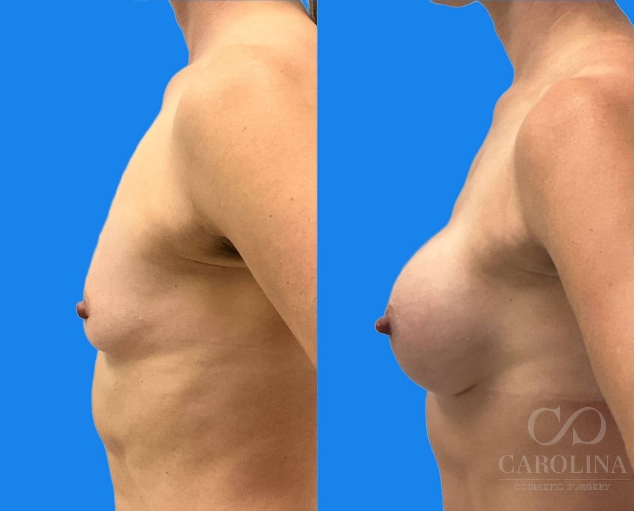 Case--5871 | Before and After Breast Augmentation 3