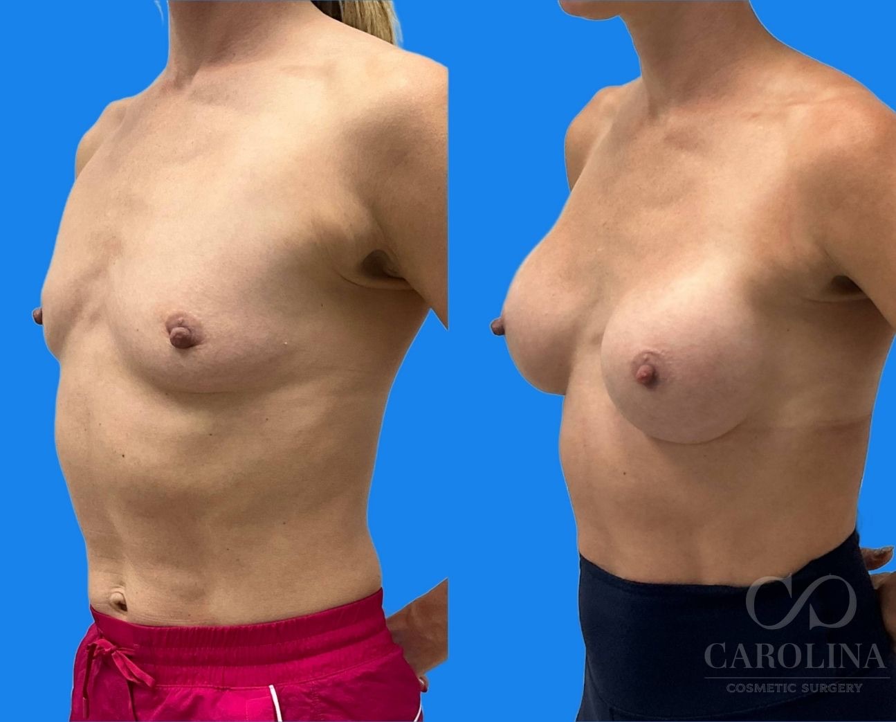 Case--5871 | Before and After Breast Augmentation 2