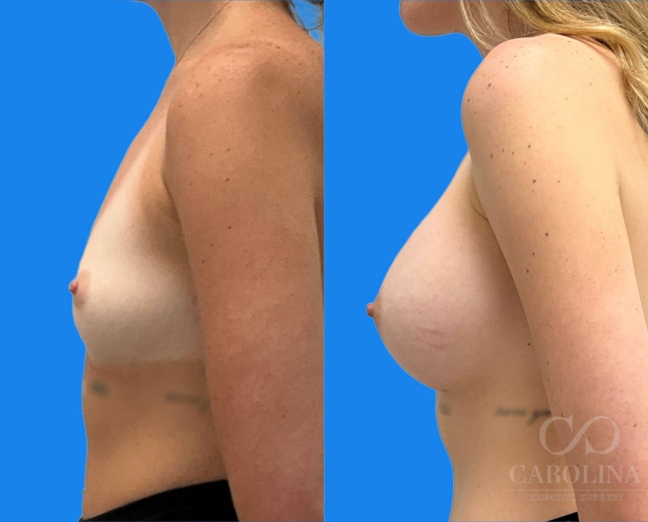 Case--5101 | Before and After Breast Augmentation 3