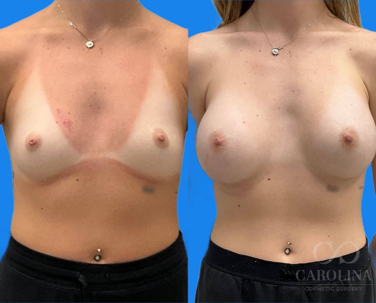 Case--5101 | Before and After Breast Augmentation