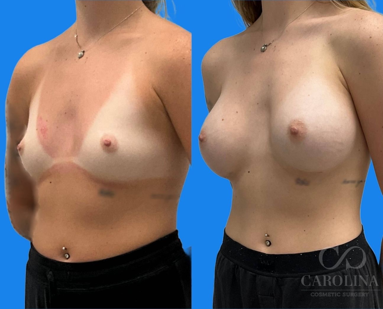 Case--5101 | Before and After Breast Augmentation 2