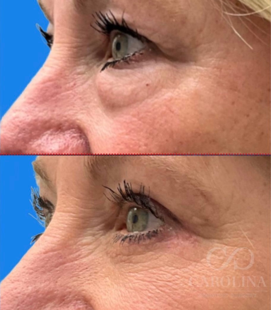 Case--6588 | Before and After Blepharoplasty 3