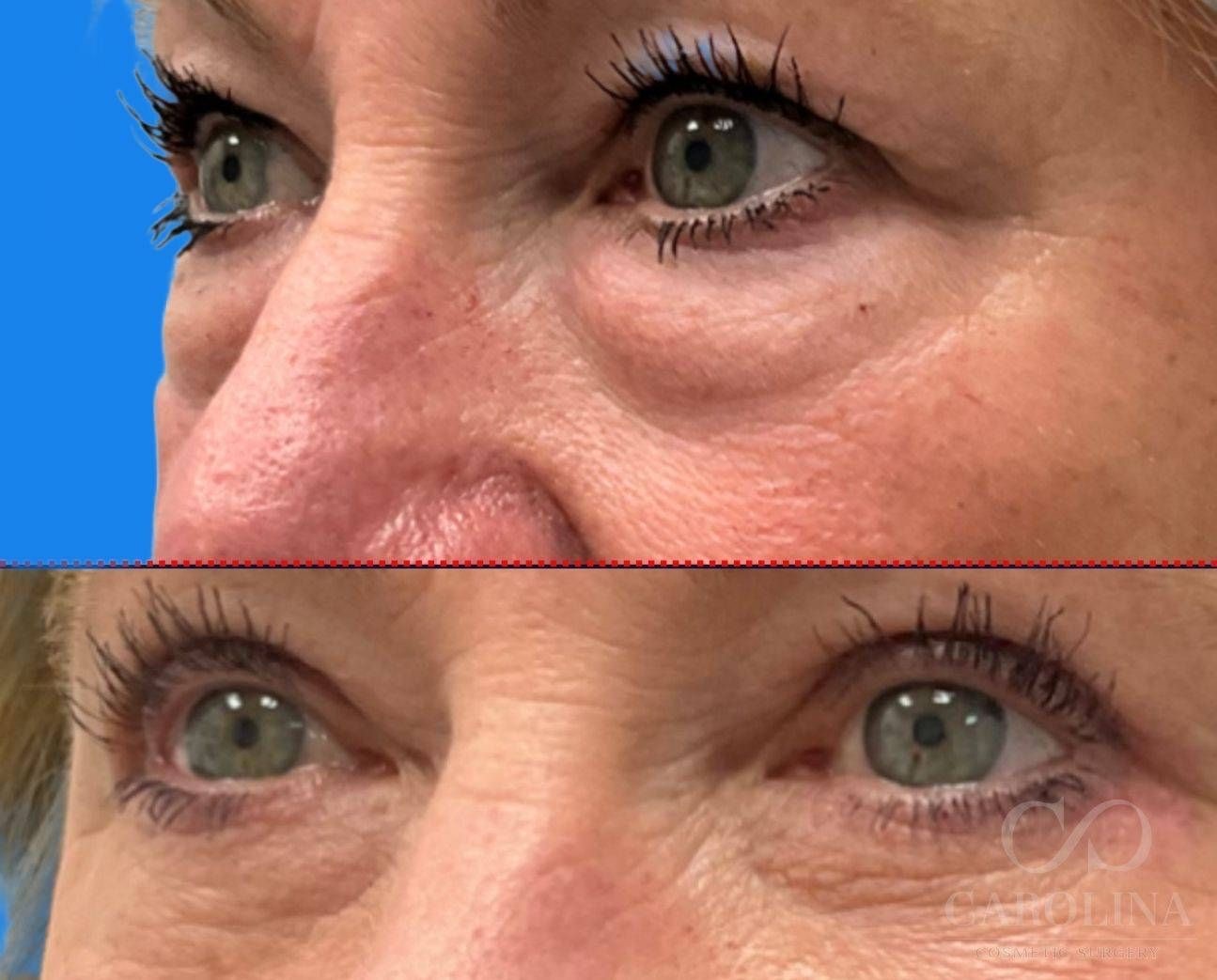 Case--6588 | Before and After Blepharoplasty 2