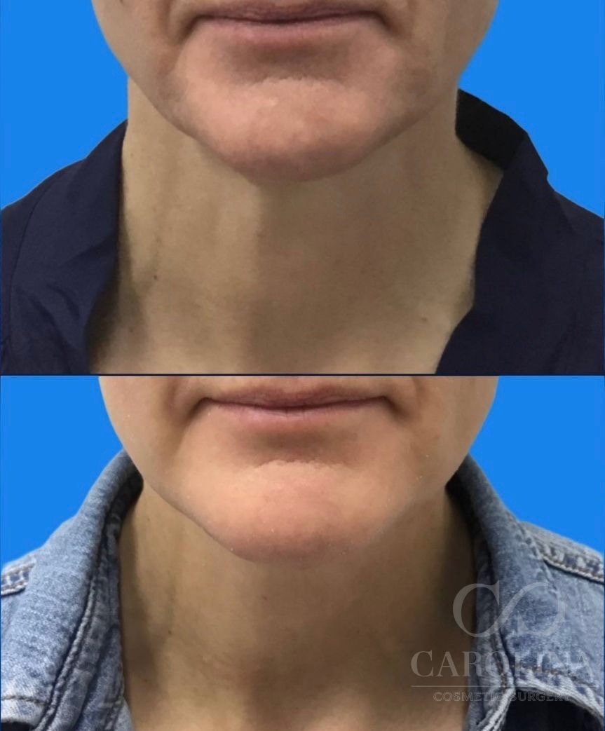 Case--6043 | Before and After Neck Liposuction + Renuvion®