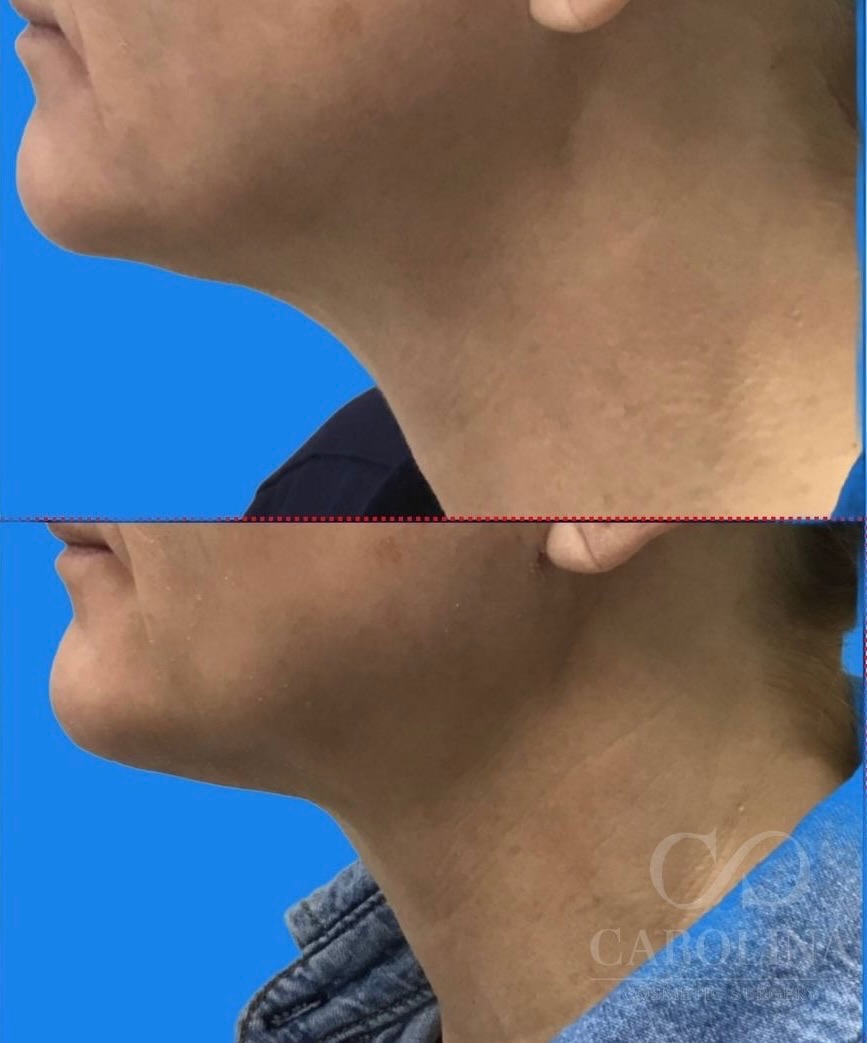 Case--6043 | Before and After Neck Liposuction + Renuvion® 2