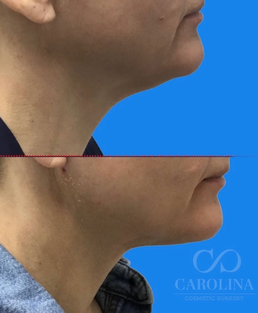 Case--6043 | Before and After Neck Liposuction + Renuvion® 3