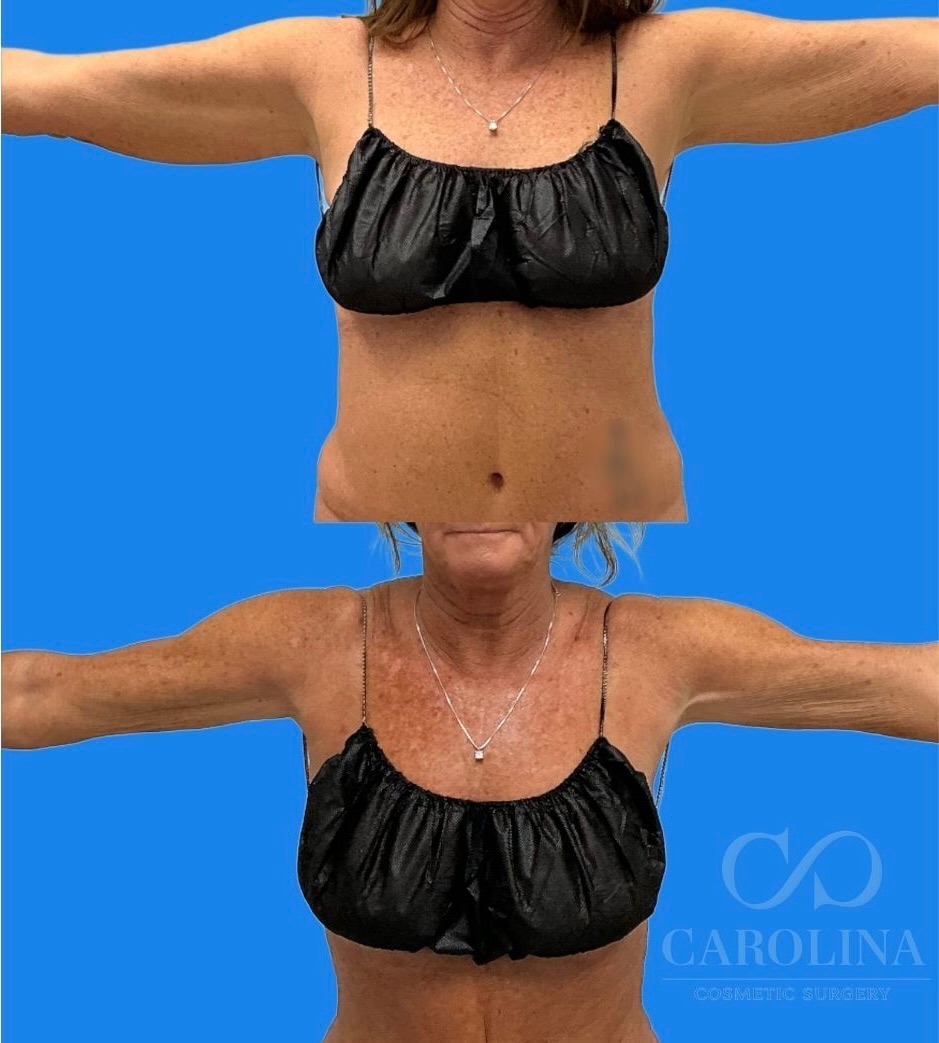 Case--9230 | Before and After Arm Sculpt 2