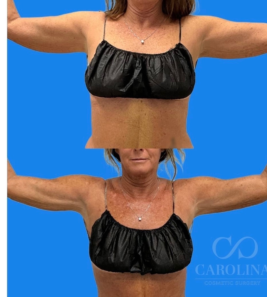 Case--9230 | Before and After Arm Sculpt