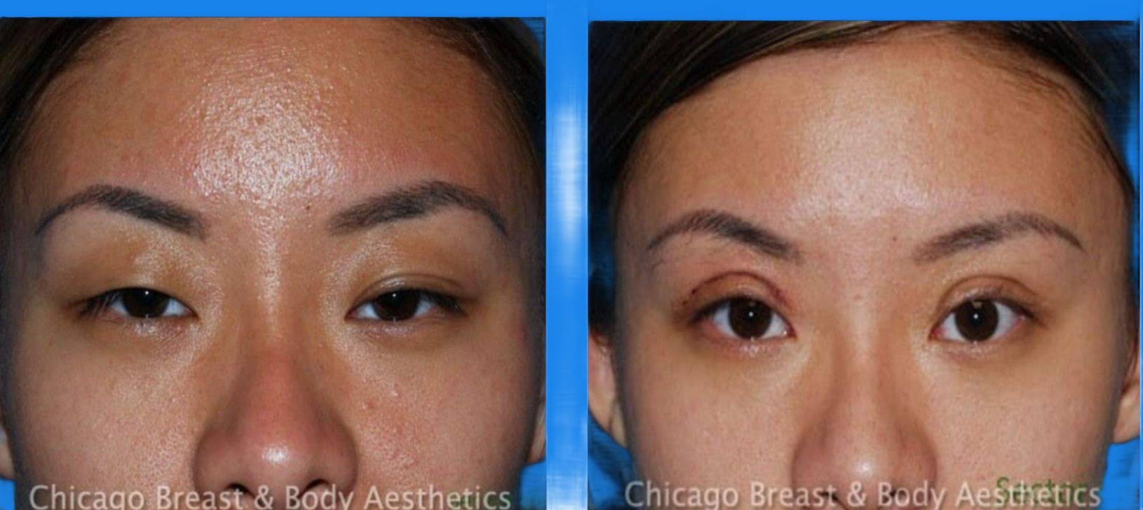 Case--9137 | Before and After Blepharoplasty