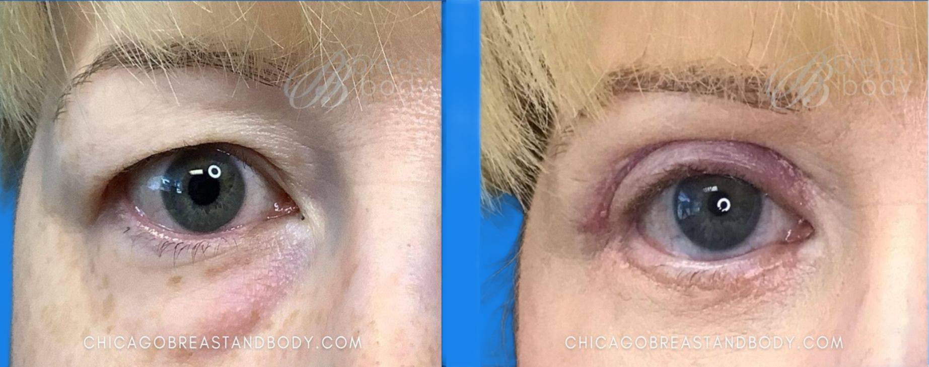 Case--8565 | Before and After Blepharoplasty
