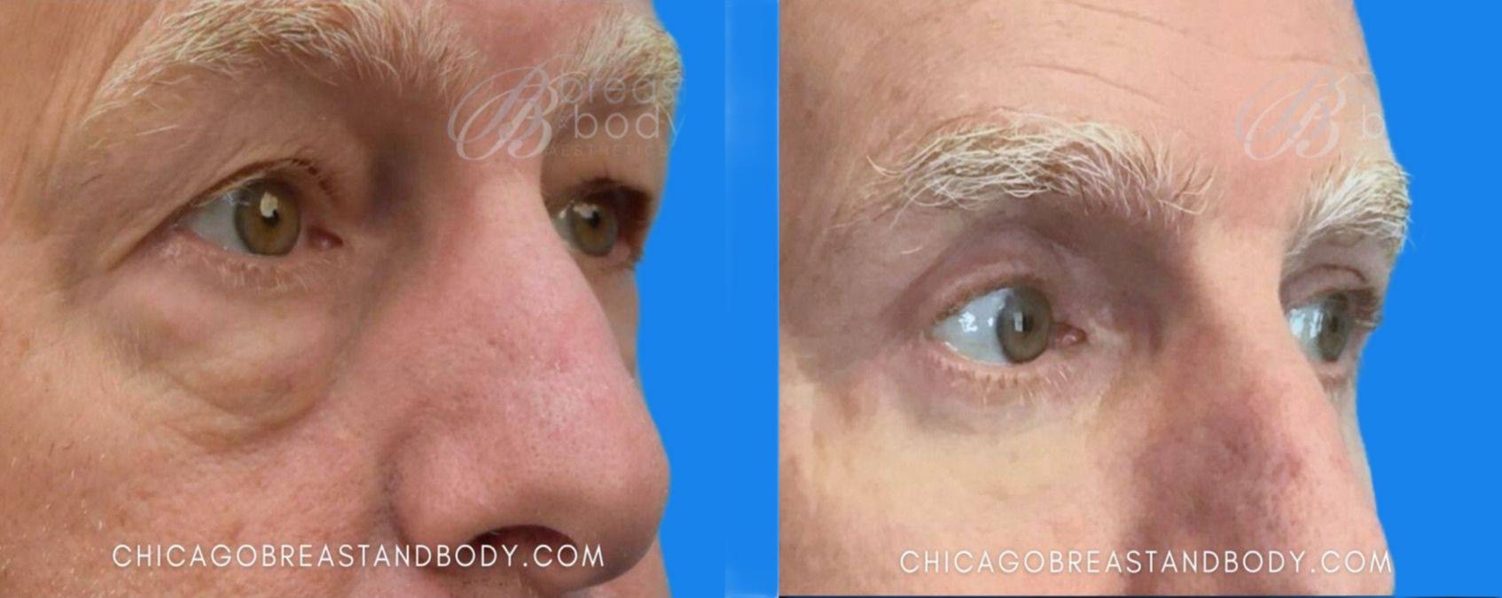 Case--3071 | Before and After Blepharoplasty