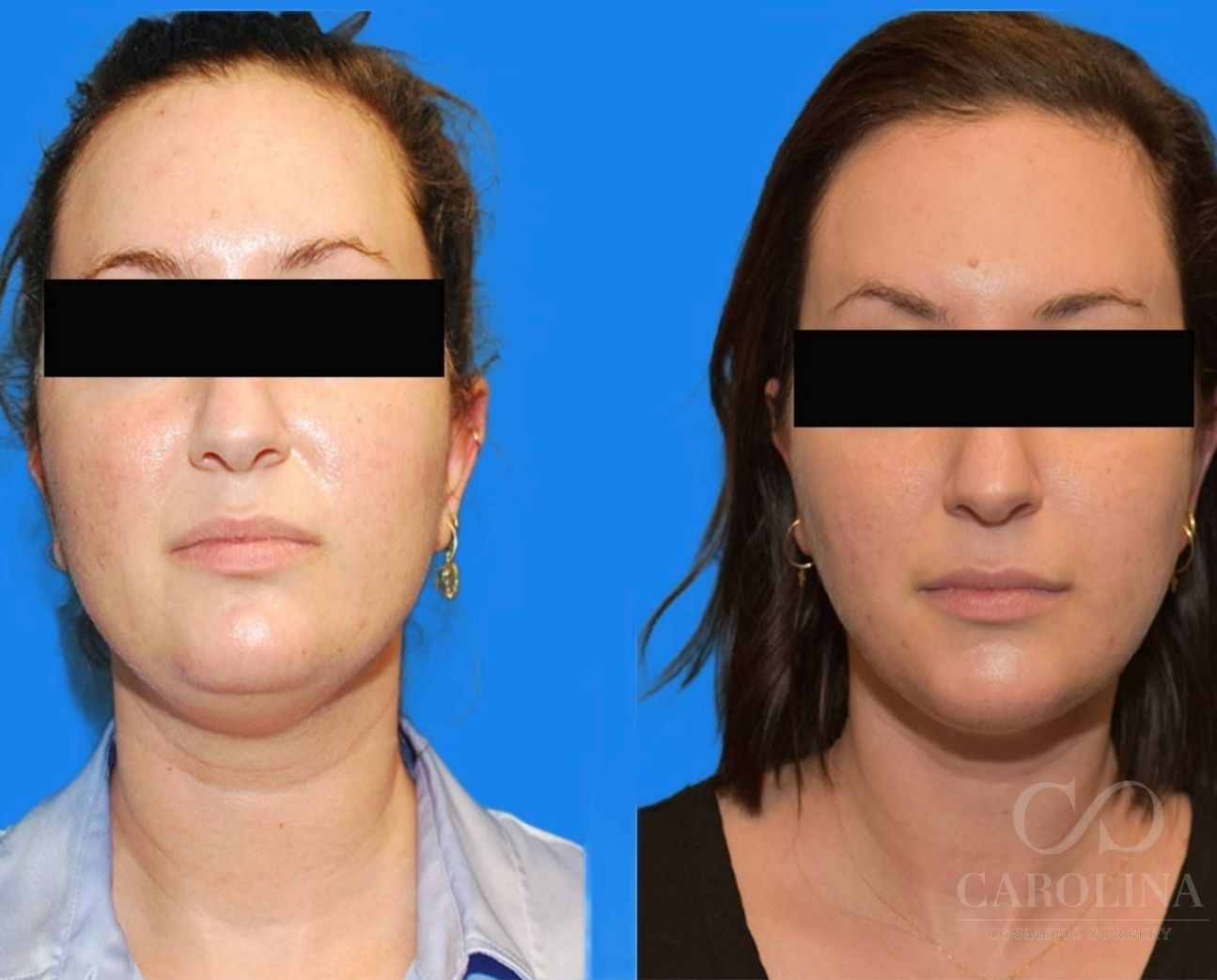 Case--6092 | Before and After Face/Neck Lift