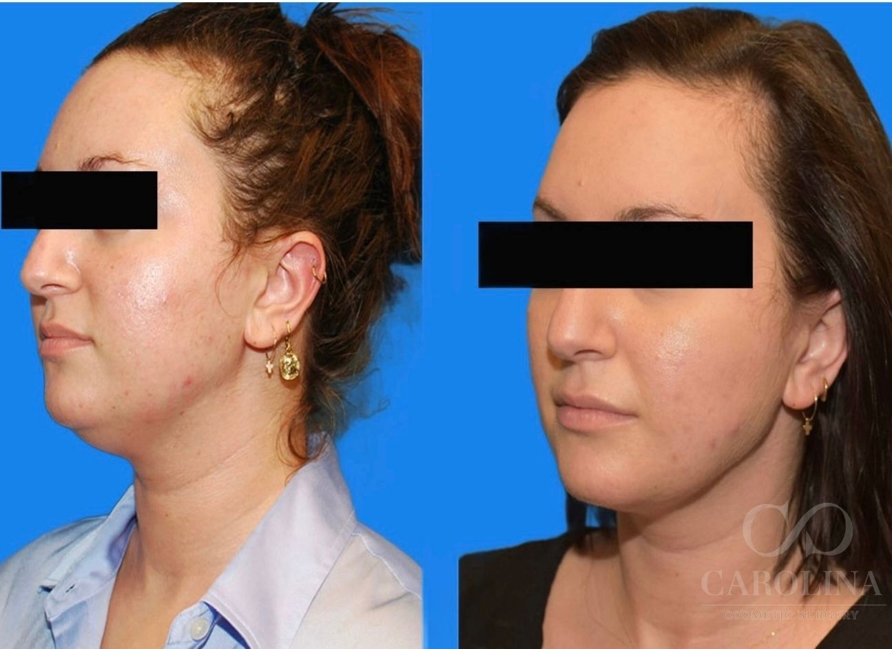 Case--6092 | Before and After Face/Neck Lift 2