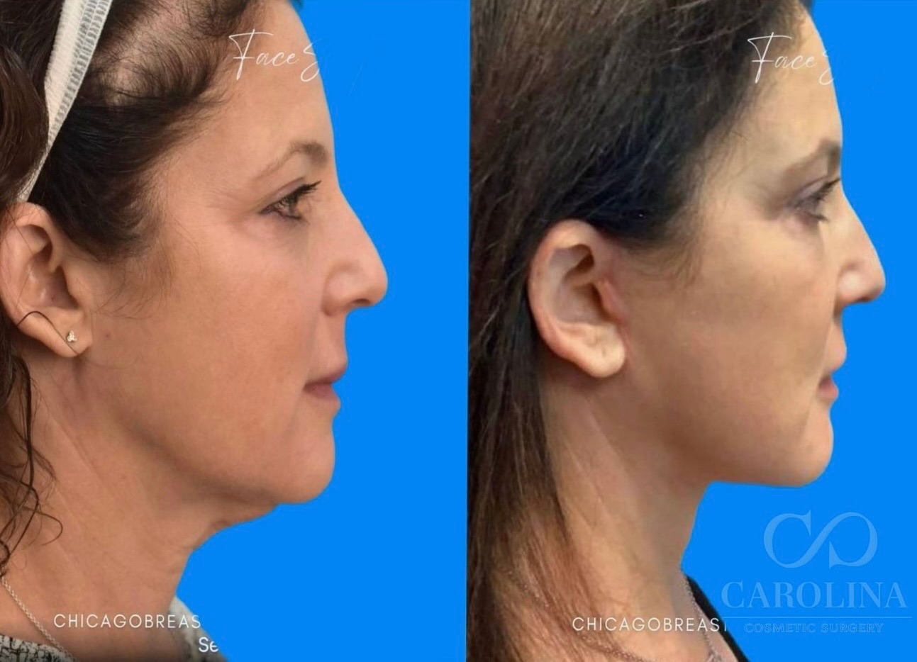 Case--6453 | Before and After Face/Neck Lift