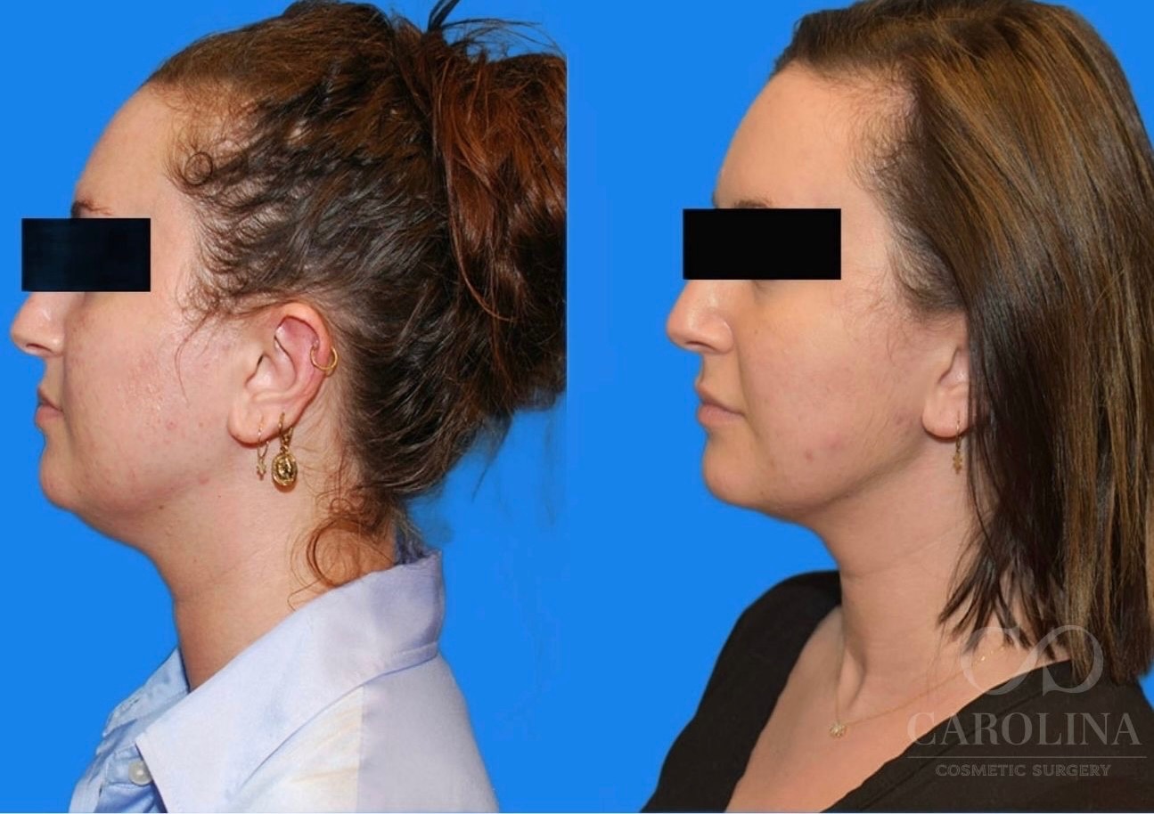 Case--6092 | Before and After Face/Neck Lift 3