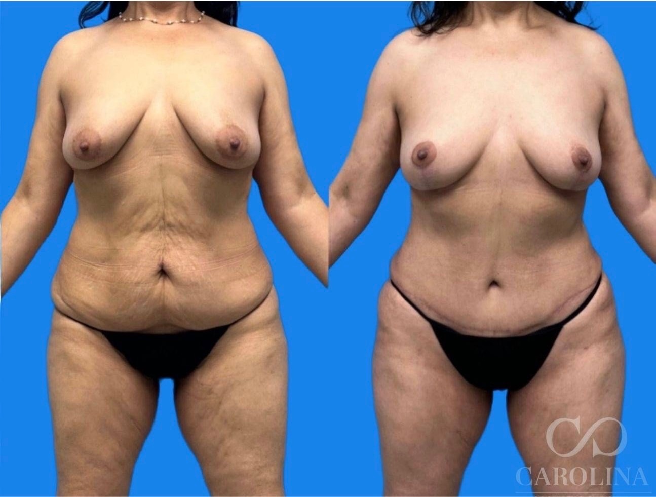 Case--5768 | Before and After Tummy Tuck