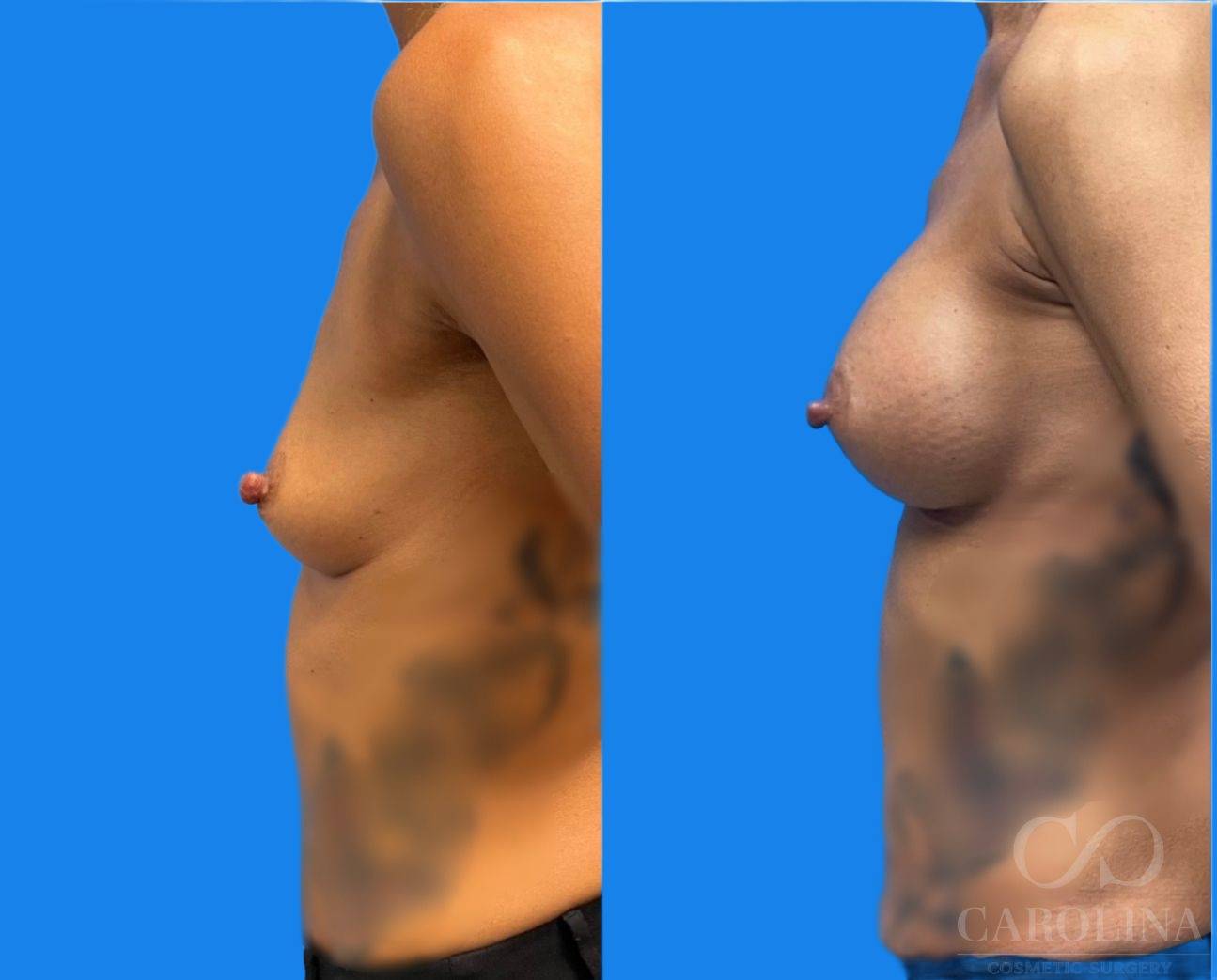 Case--4474 | Before and After Breast Augmentation 3