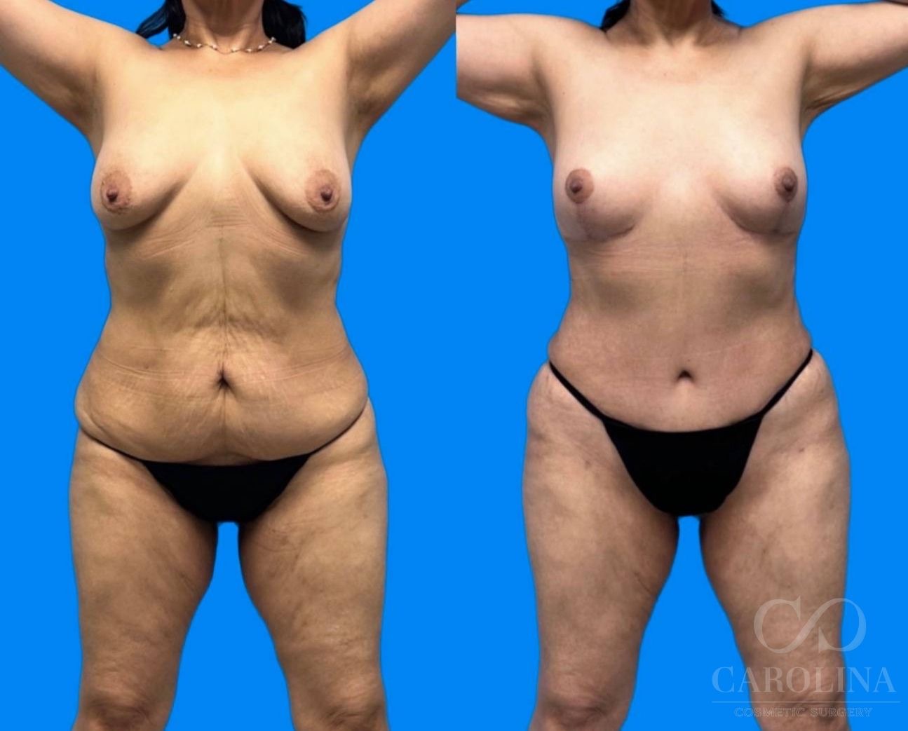 Case--5768 | Before and After Breast Lift 4