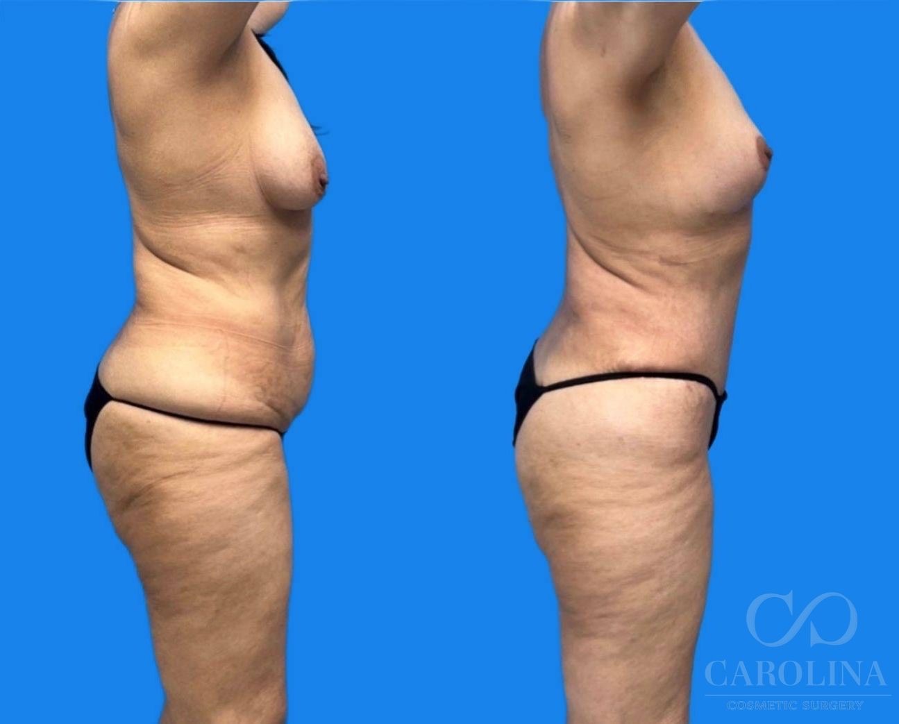 Case--5768 | Before and After Breast Lift 2