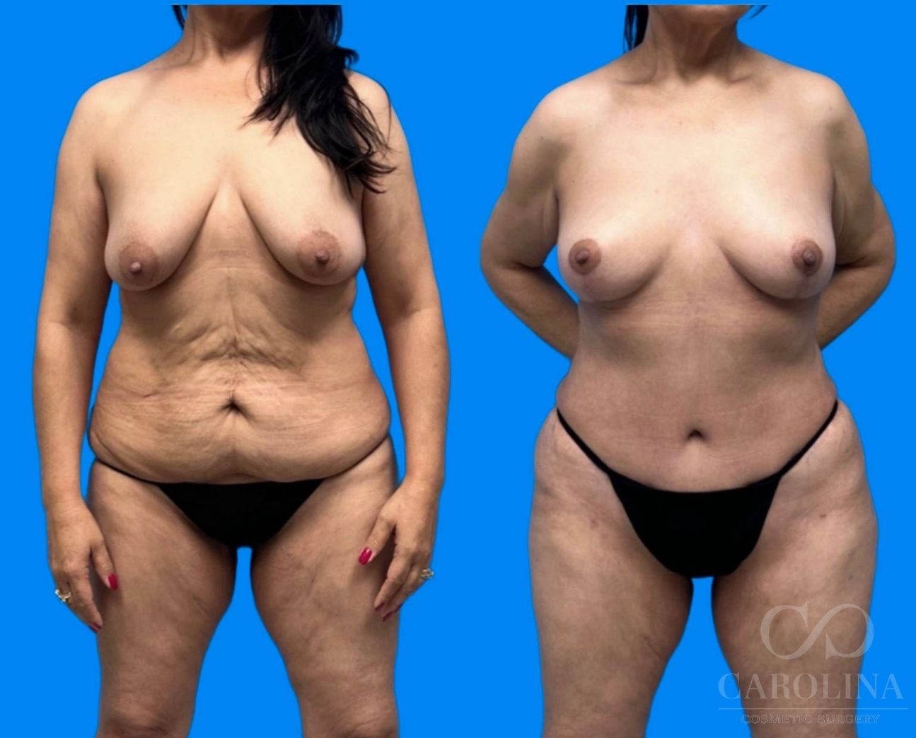 Case--5768 | Before and After Breast Lift 5