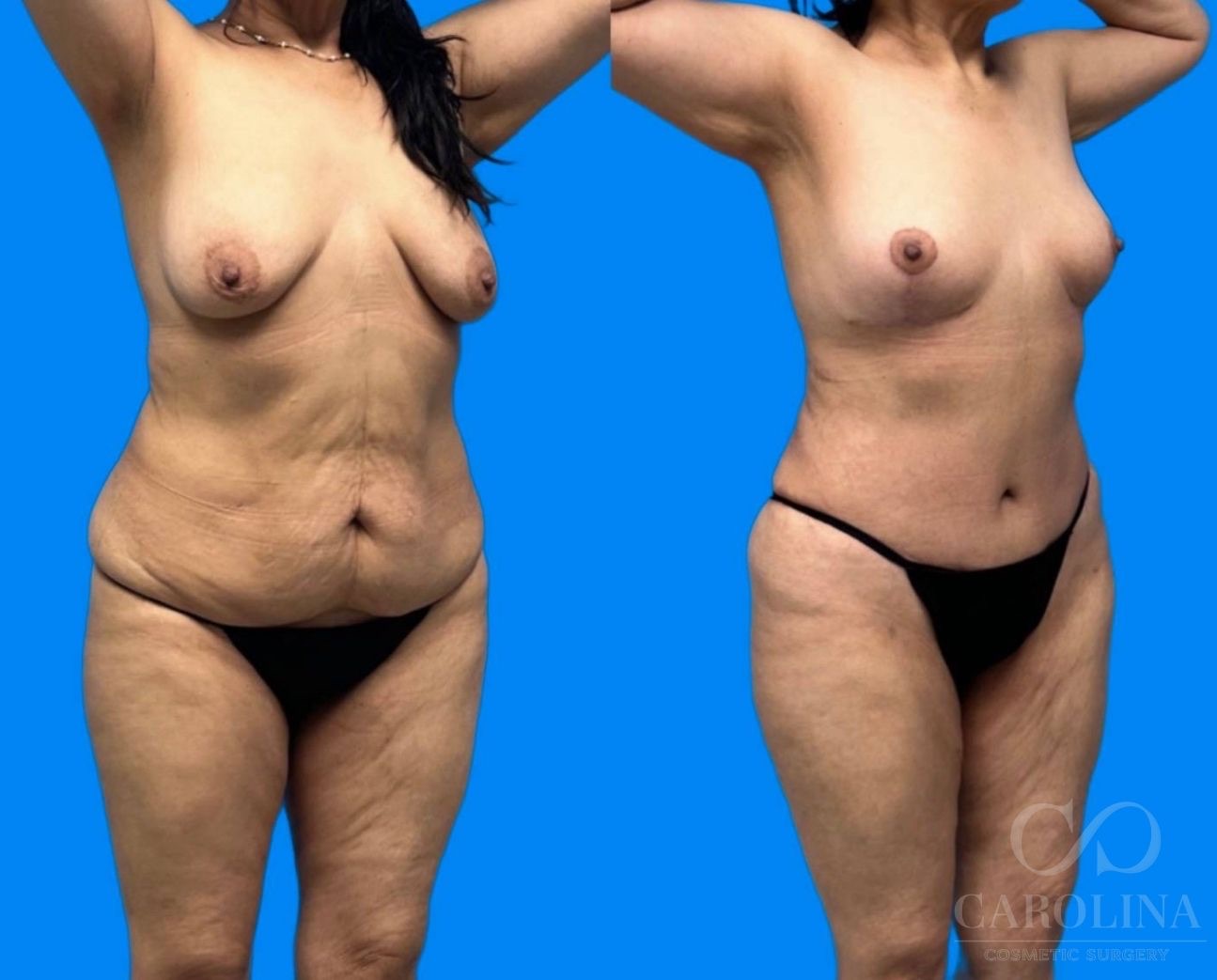 Case--5768 | Before and After Breast Lift 3