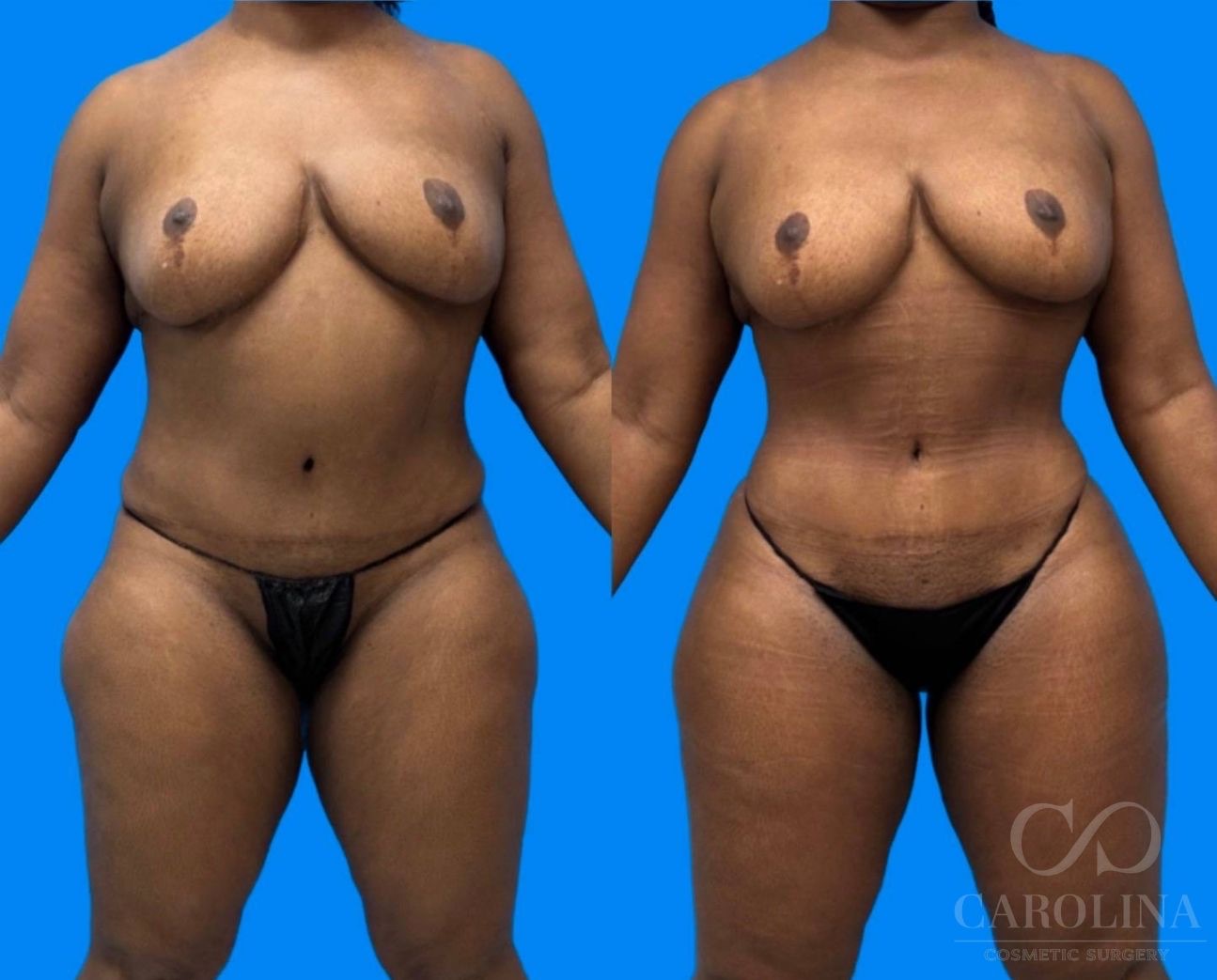 Case--4733 | Before and After Brazilian Butt Lift 4