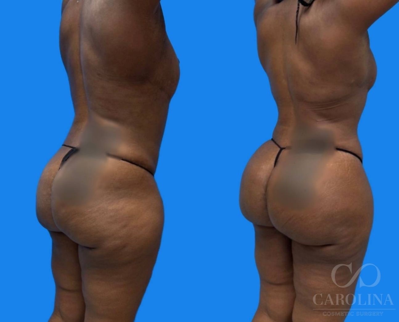 Case--4489 | Before and After Lipo 360 2