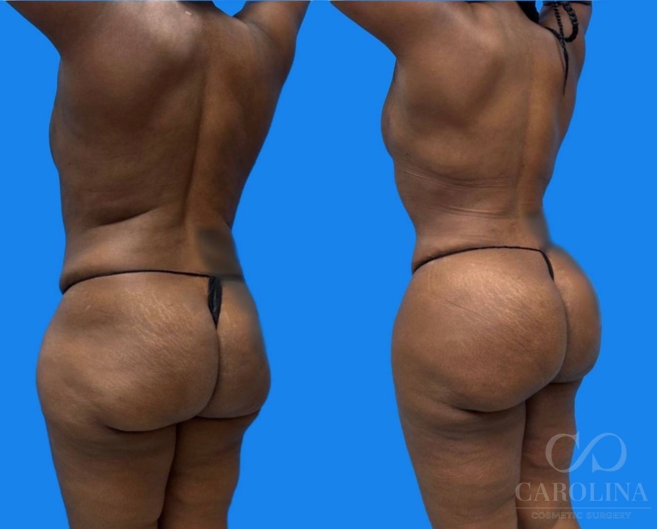 Case--4489 | Before and After Lipo 360 3