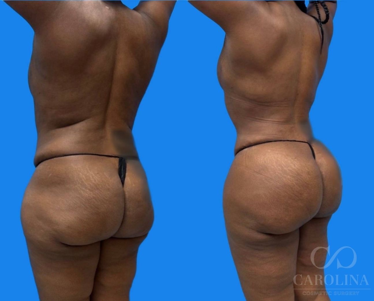 Case--4733 | Before and After Brazilian Butt Lift 2
