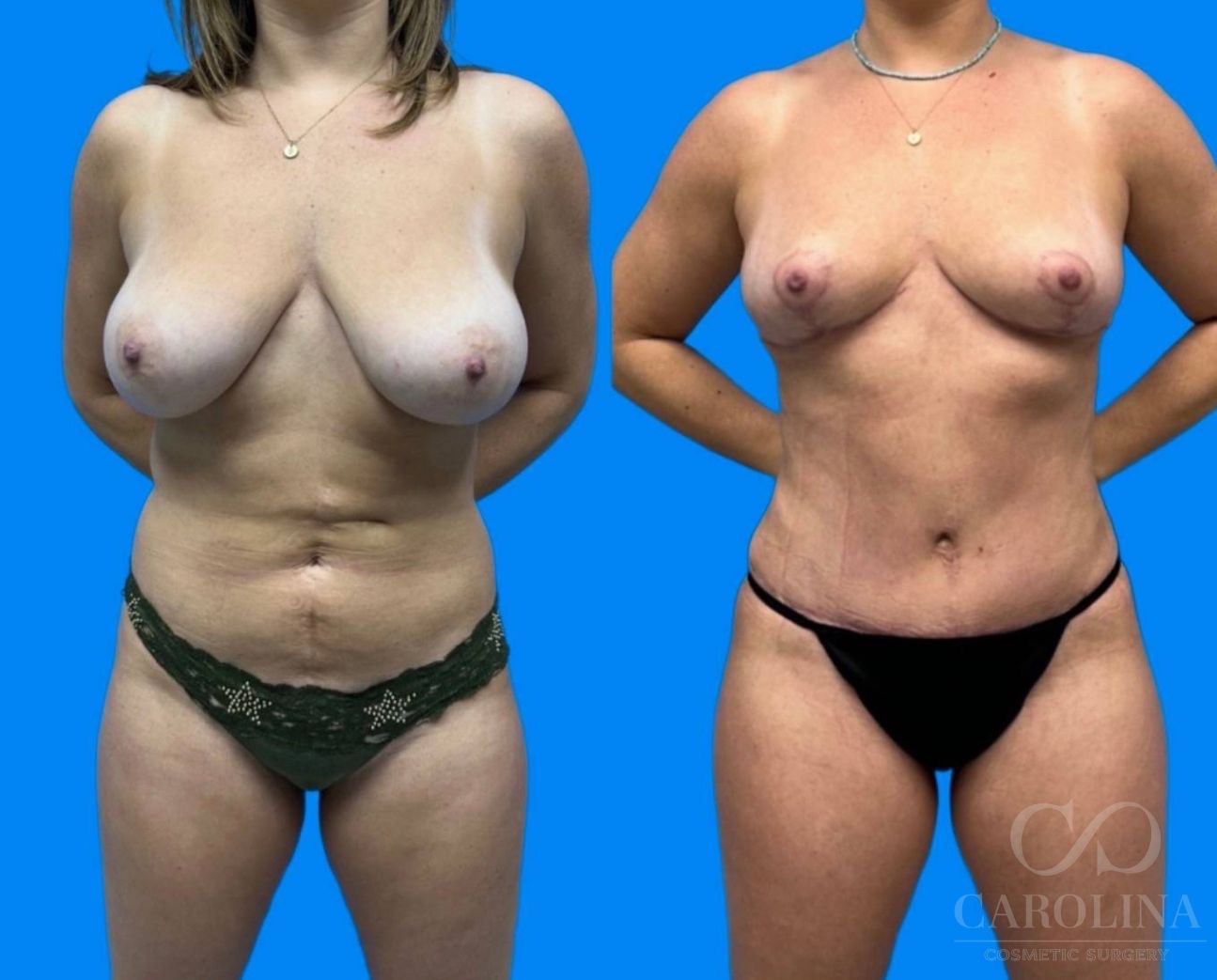 Case--9777 | Before and After Breast Lift 4