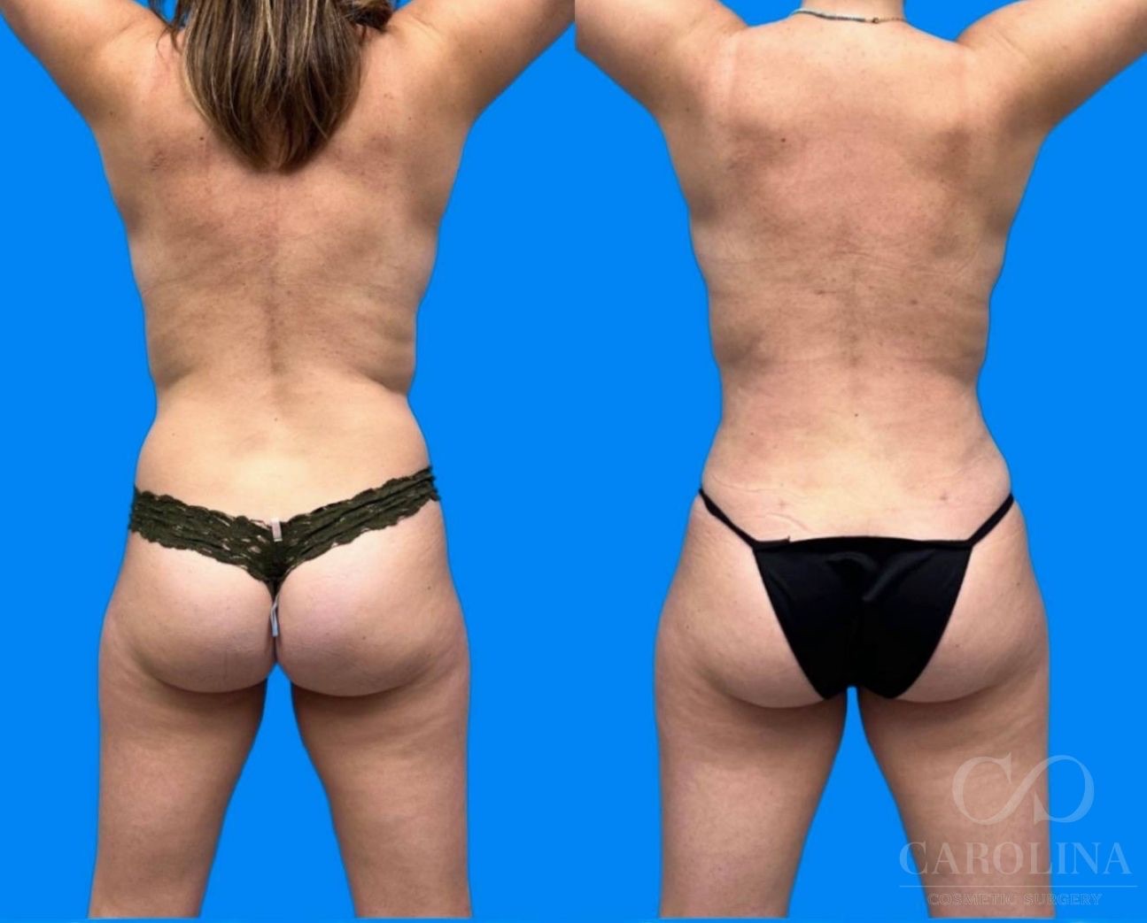 Case--9777 | Before and After Breast Lift 2