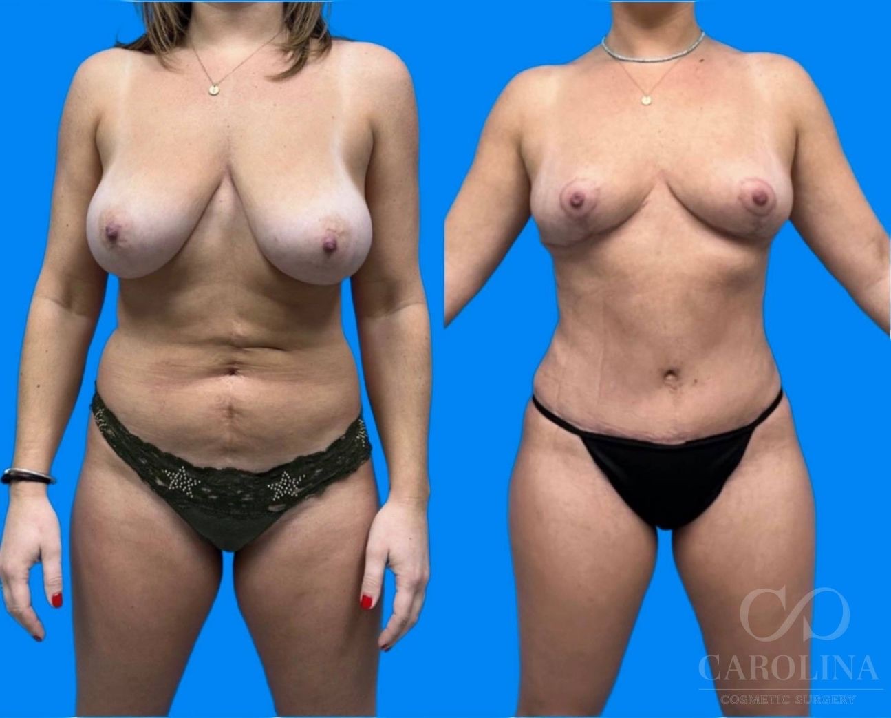 Case--9777 | Before and After Tummy Tuck