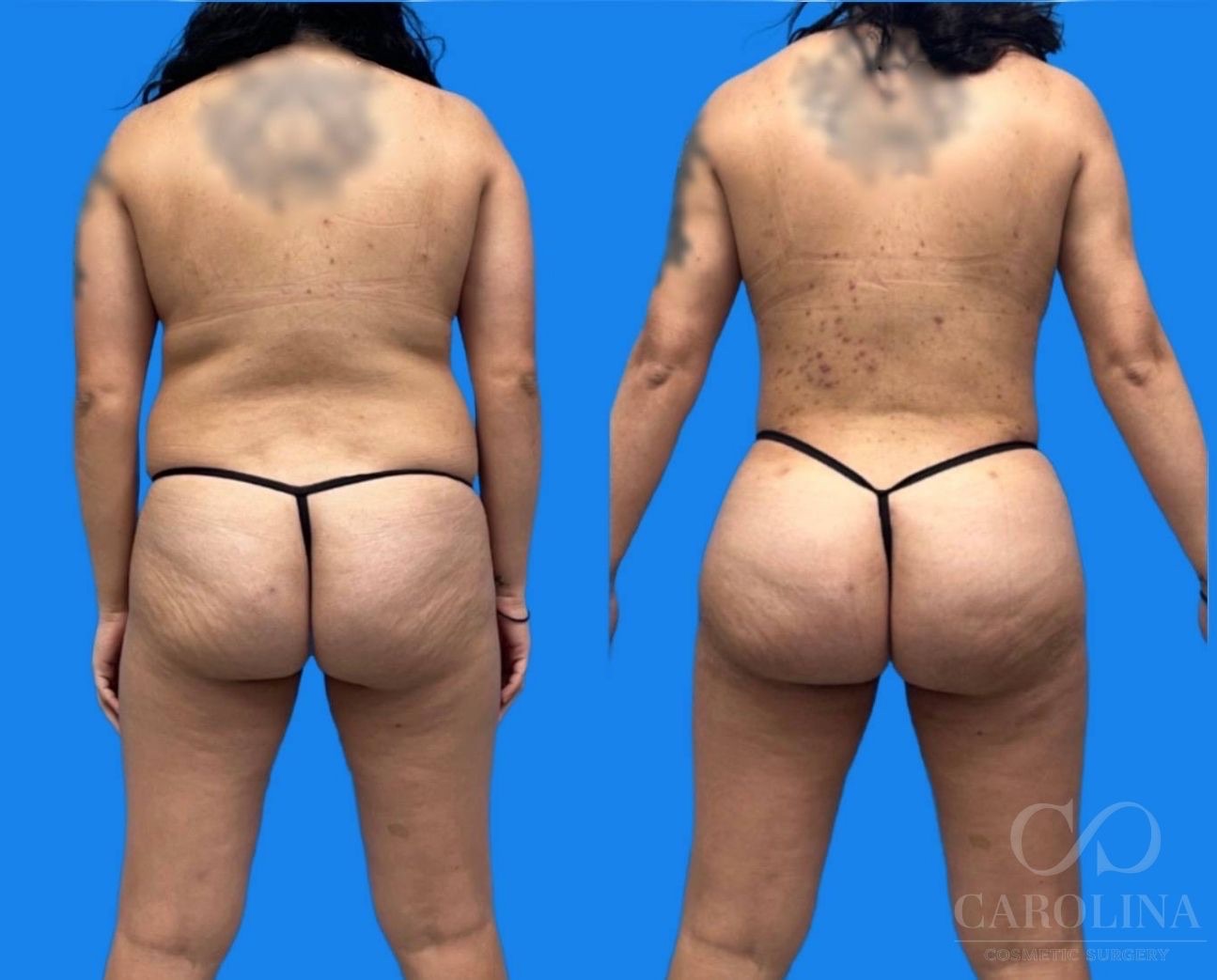 Case--6462 | Before and After Brazilian Butt Lift
