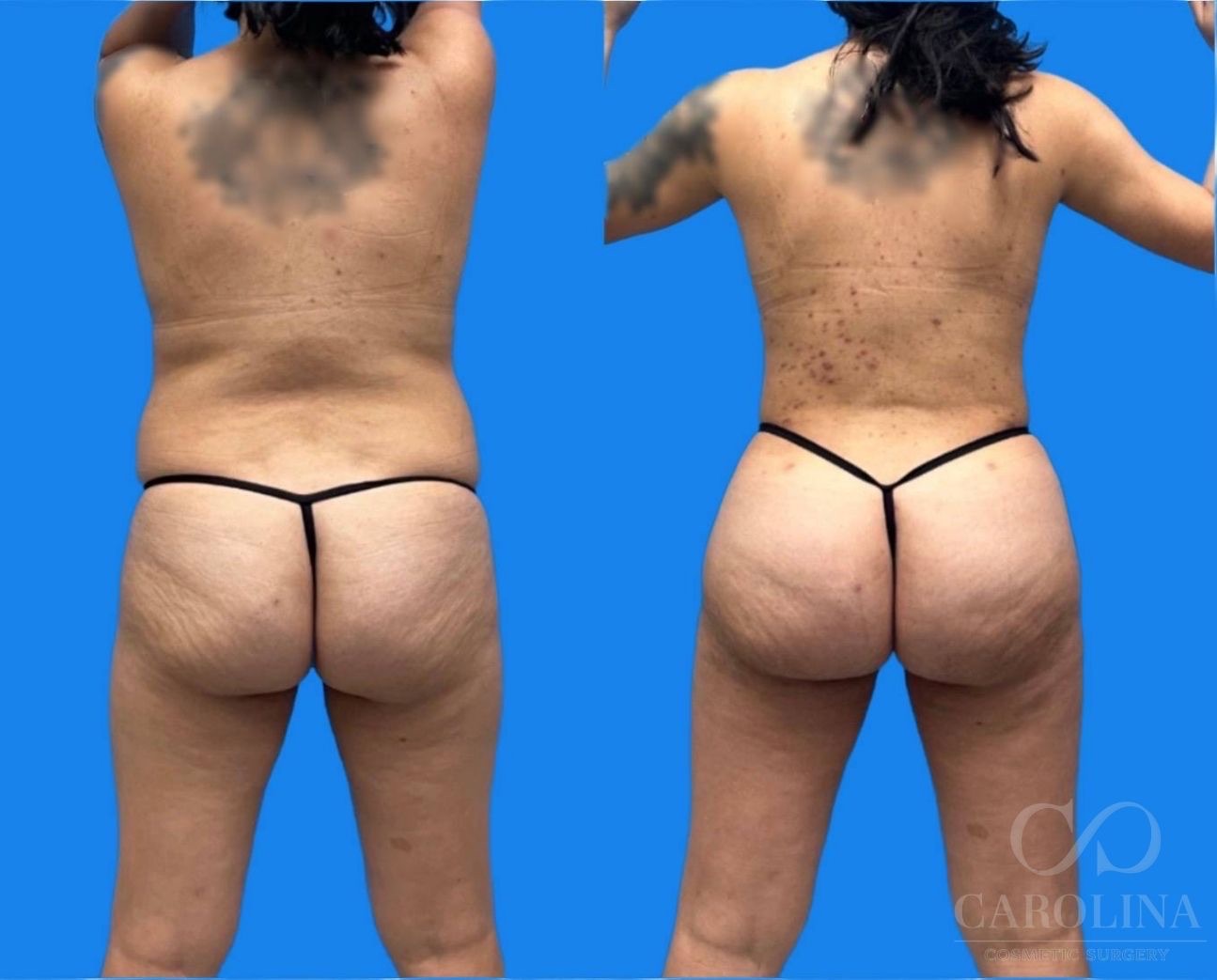 Case--5250 | Before and After Lipo 360 4