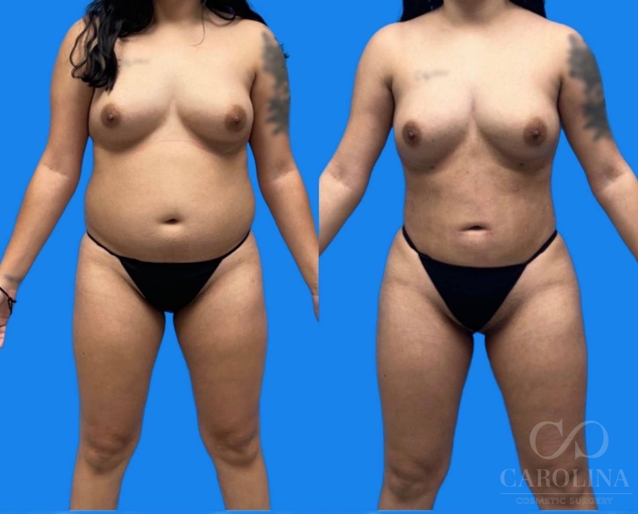 Case--5250 | Before and After Lipo 360