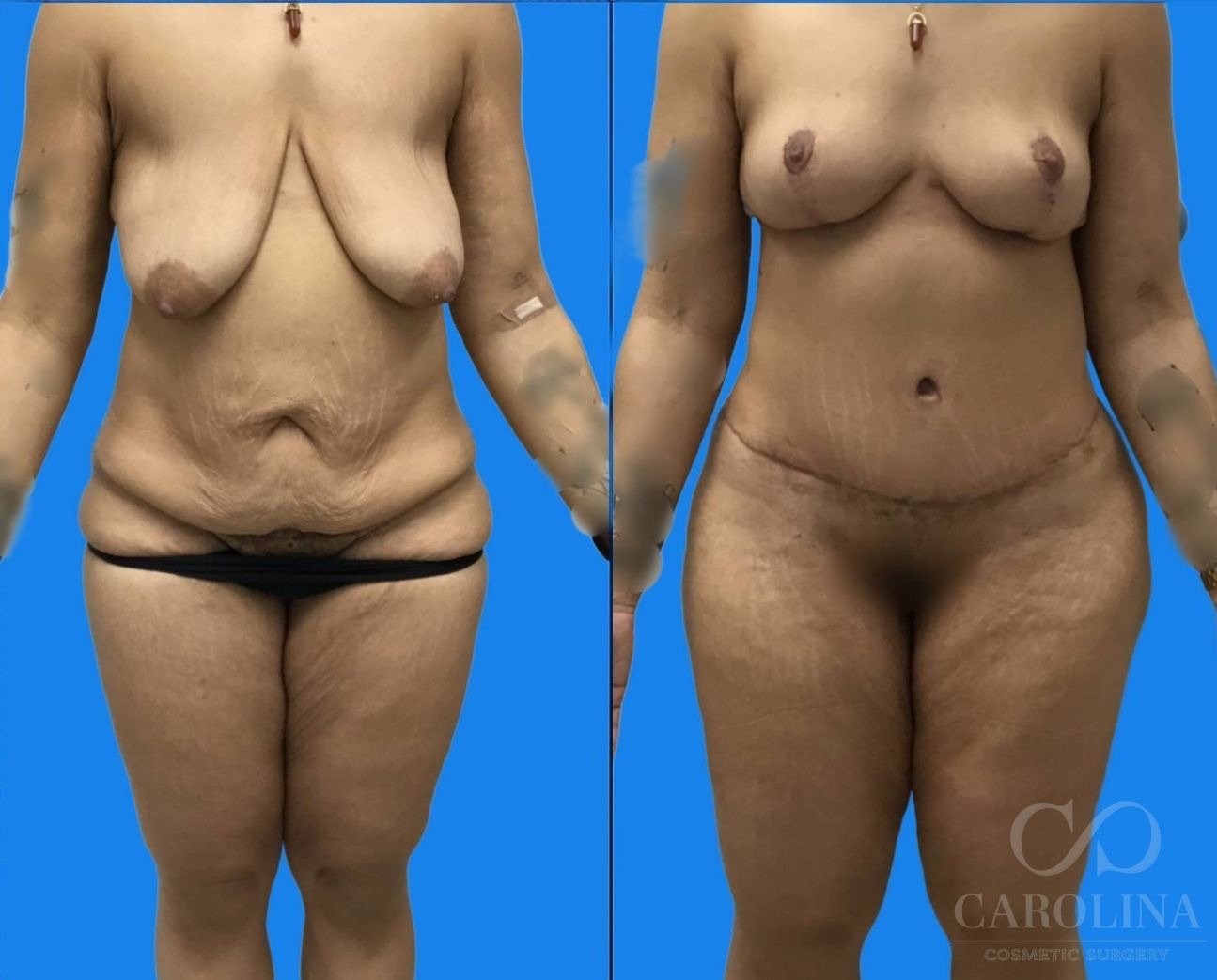 Case--2093 | Before and After Breast Lift 5